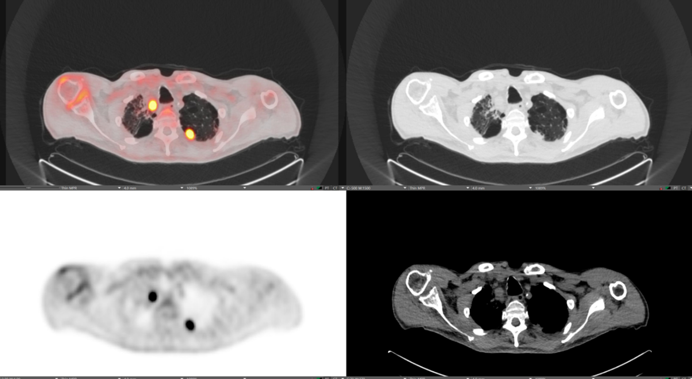 PET-CT scan